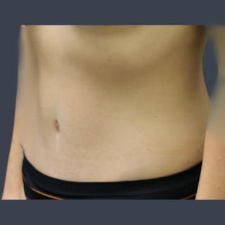 Abdominoplasty / Tummy Tuck Before & After Gallery - Patient 275267 - Image 4