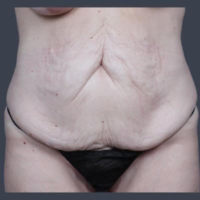 Abdominoplasty / Tummy Tuck Before & After Gallery - Patient 117573 - Image 1