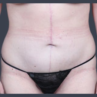 Abdominoplasty / Tummy Tuck Before & After Gallery - Patient 117573 - Image 2