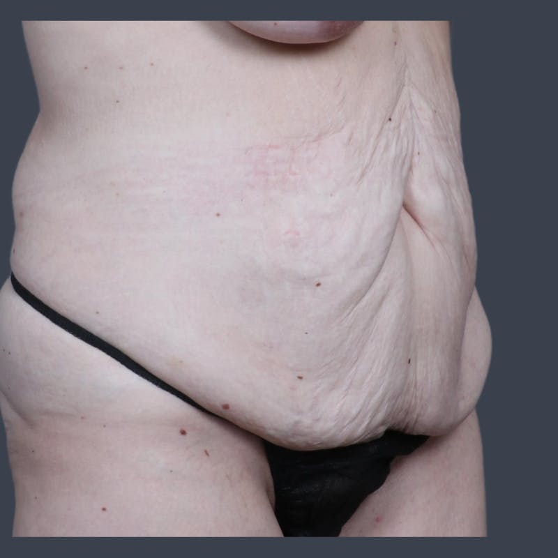 Abdominoplasty / Tummy Tuck Before & After Gallery - Patient 117573 - Image 5