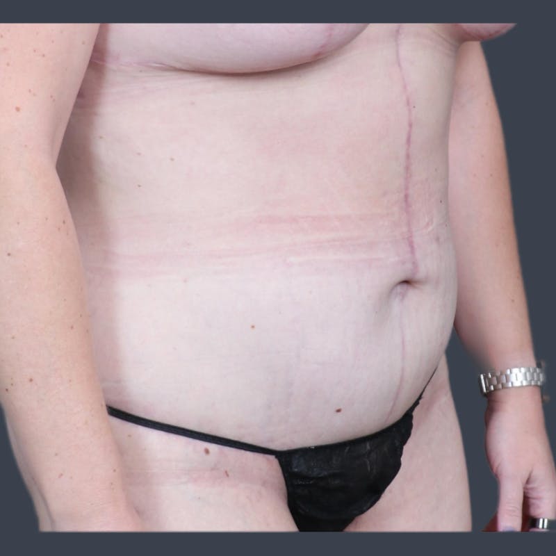 Abdominoplasty / Tummy Tuck Before & After Gallery - Patient 117573 - Image 6