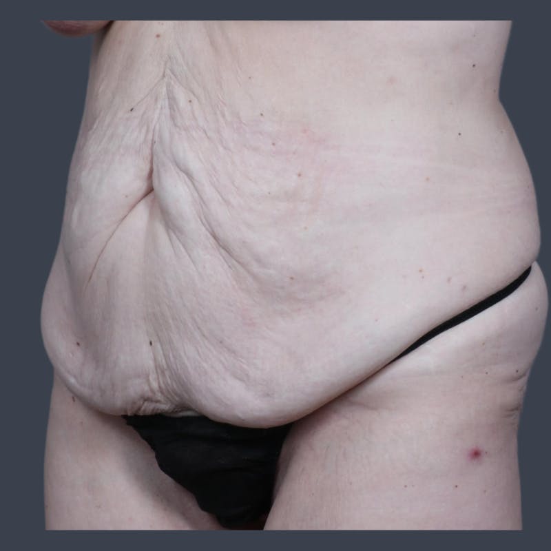 Abdominoplasty / Tummy Tuck Before & After Gallery - Patient 117573 - Image 3
