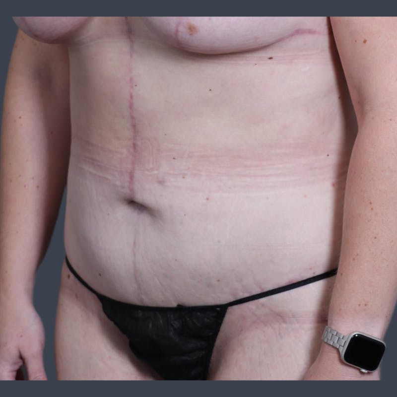 Abdominoplasty / Tummy Tuck Before & After Gallery - Patient 117573 - Image 4