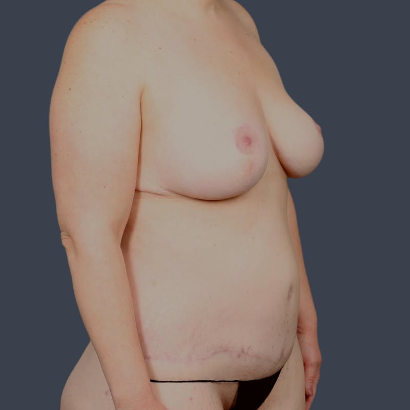 Mommy Makeover Before & After Gallery - Patient 331842 - Image 6