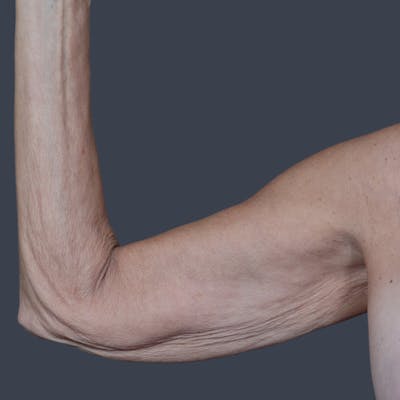 Arm Lift Before & After Gallery - Patient 468782 - Image 1