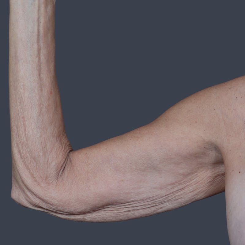 Arm Lift Before & After Gallery - Patient 468782 - Image 1