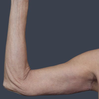 Arm Lift Before & After Gallery - Patient 468782 - Image 2
