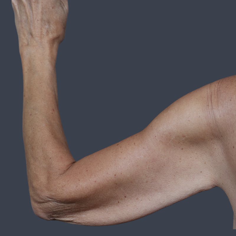 Arm Lift Before & After Gallery - Patient 468782 - Image 3