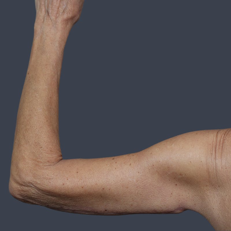 Arm Lift Before & After Gallery - Patient 468782 - Image 4