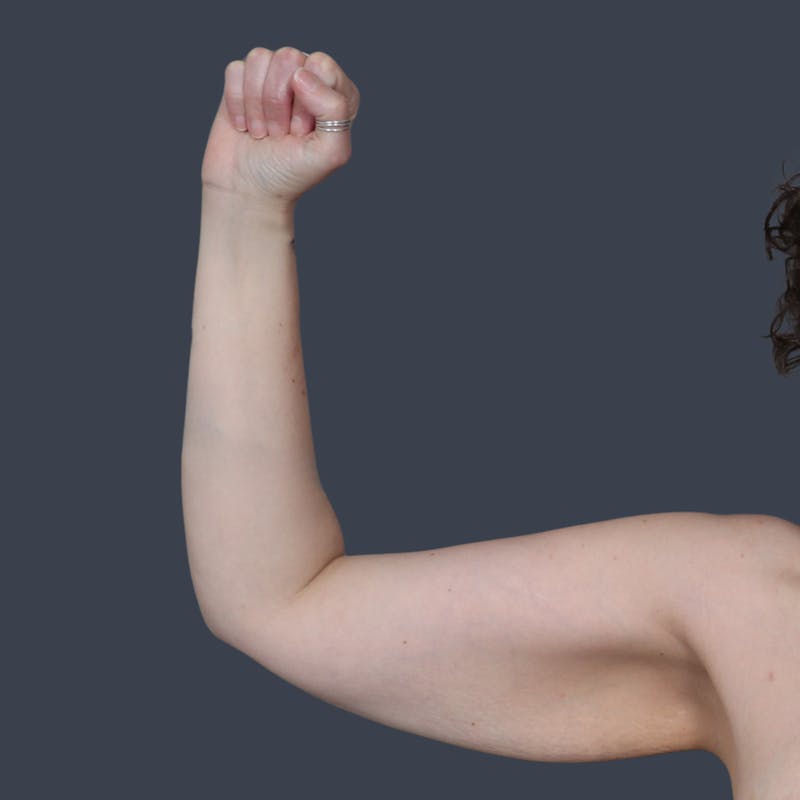 Arm Lift Before & After Gallery - Patient 273073 - Image 1