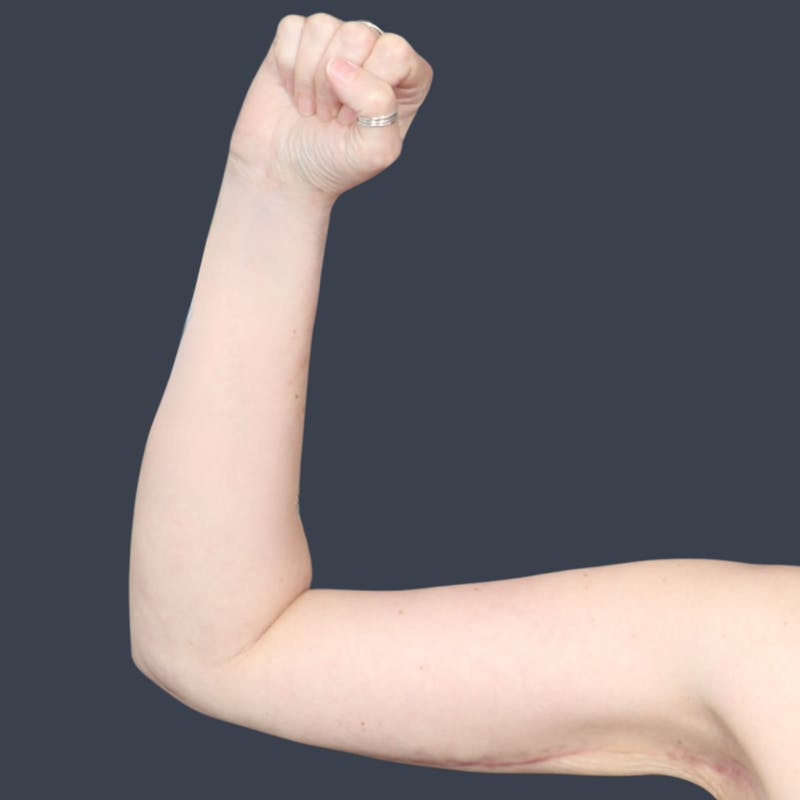 Arm Lift Before & After Gallery - Patient 273073 - Image 2