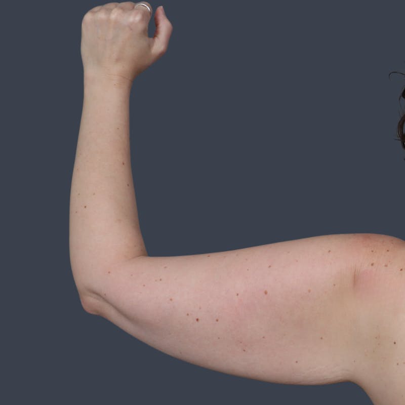 Arm Lift Before & After Gallery - Patient 273073 - Image 3