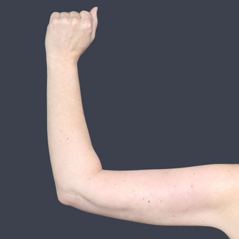 Arm Lift Before & After Gallery - Patient 273073 - Image 4