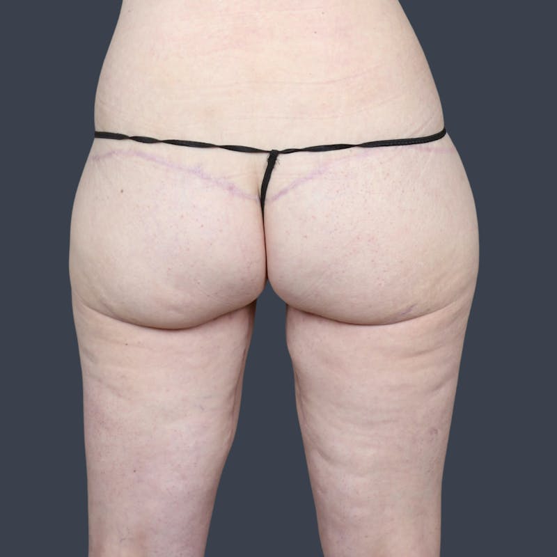 Thigh Lift Before & After Gallery - Patient 230825 - Image 4