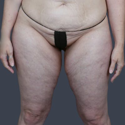 Thigh Lift Before & After Gallery - Patient 230825 - Image 1