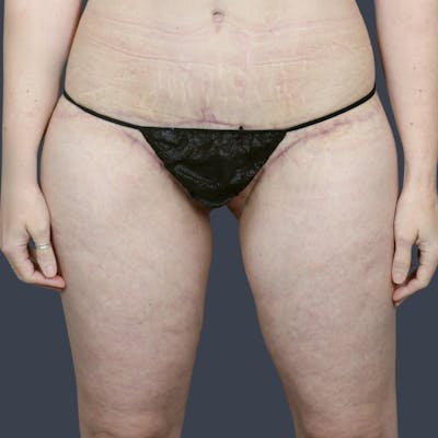 Thigh Lift Before & After Gallery - Patient 230825 - Image 2