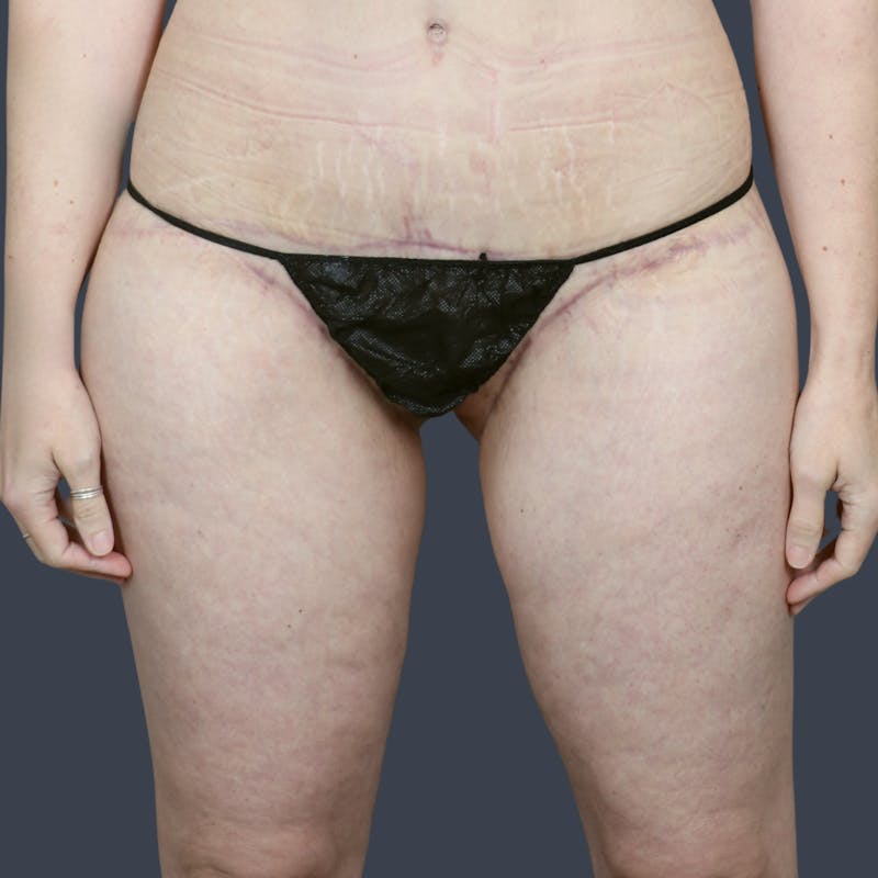 Thigh Lift Before & After Gallery - Patient 230825 - Image 2