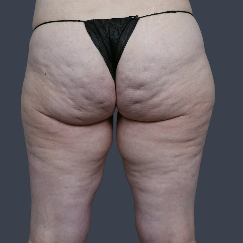 Thigh Lift Before & After Gallery - Patient 230825 - Image 3