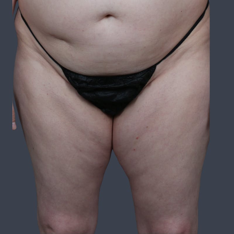 Thigh Lift Before & After Gallery - Patient 398345 - Image 1