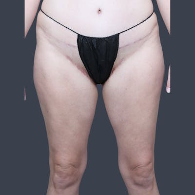 Thigh Lift Before & After Gallery - Patient 398345 - Image 2