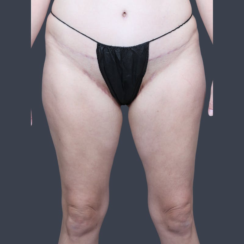 Thigh Lift Before & After Gallery - Patient 398345 - Image 2