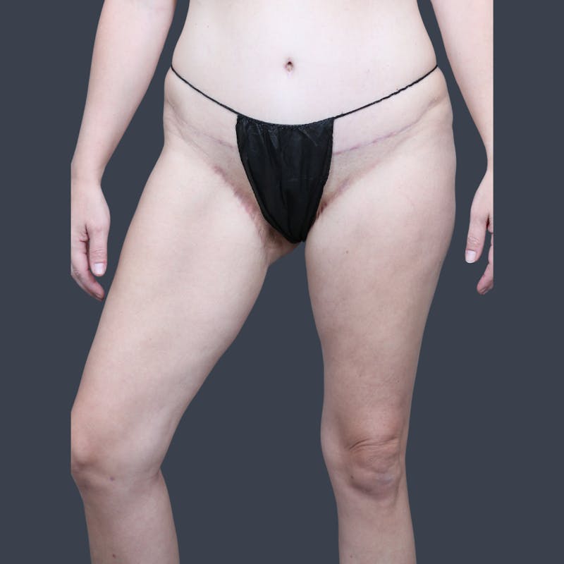 Thigh Lift Before & After Gallery - Patient 398345 - Image 4