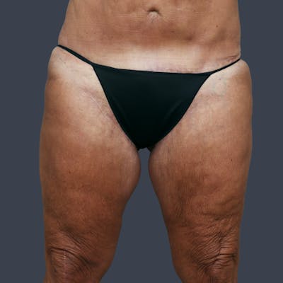 Thigh Lift Before & After Gallery - Patient 425703 - Image 2