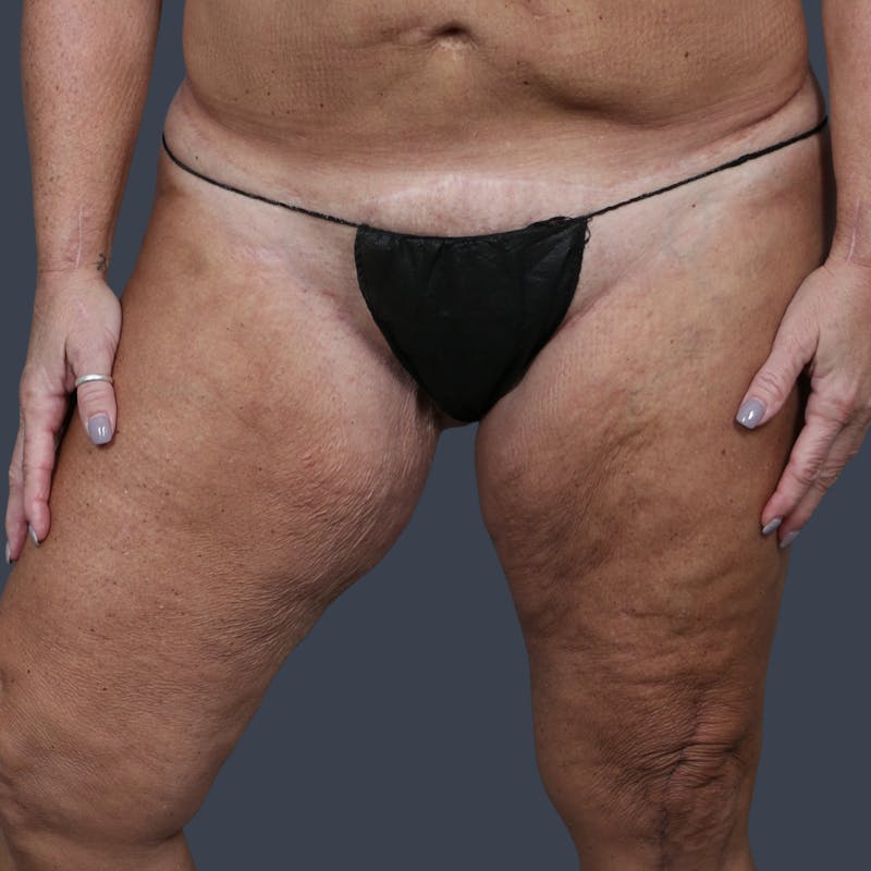Thigh Lift Before & After Gallery - Patient 425703 - Image 3