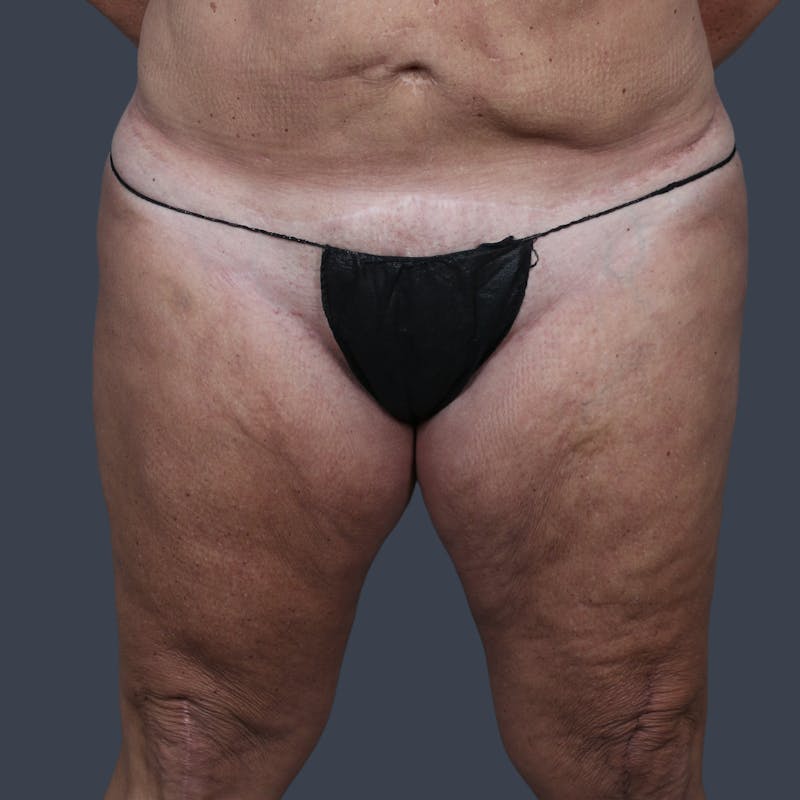 Thigh Lift Before & After Gallery - Patient 425703 - Image 1