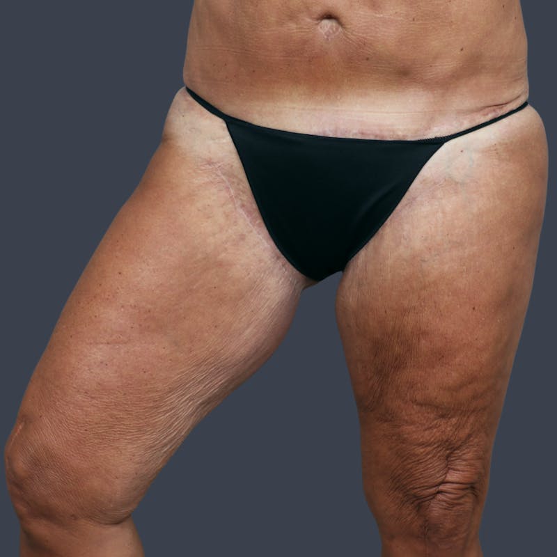 Thigh Lift Before & After Gallery - Patient 425703 - Image 4