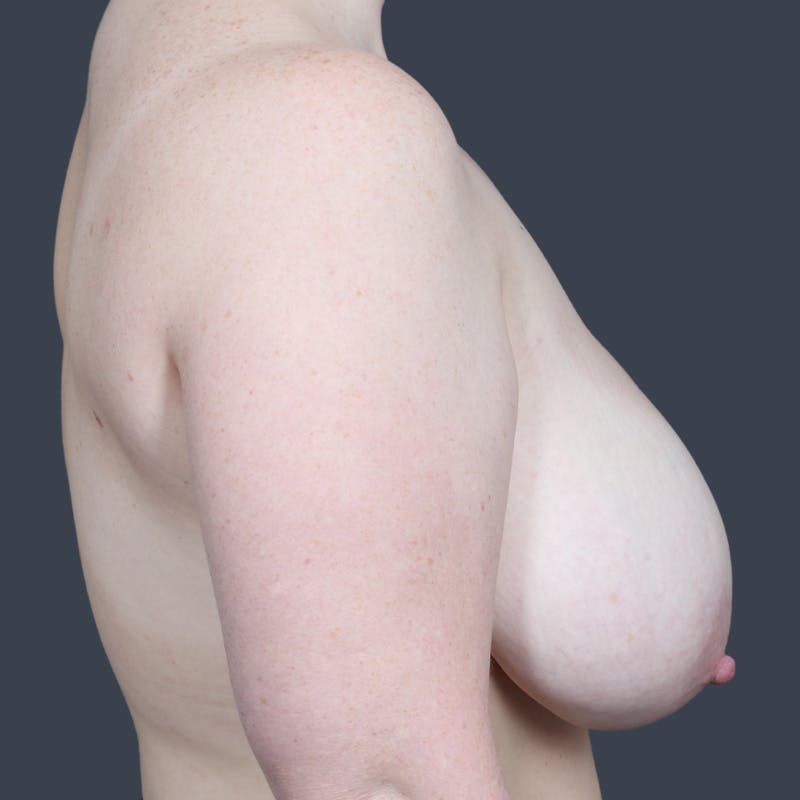 Breast Reduction Before & After Gallery - Patient 397944 - Image 5