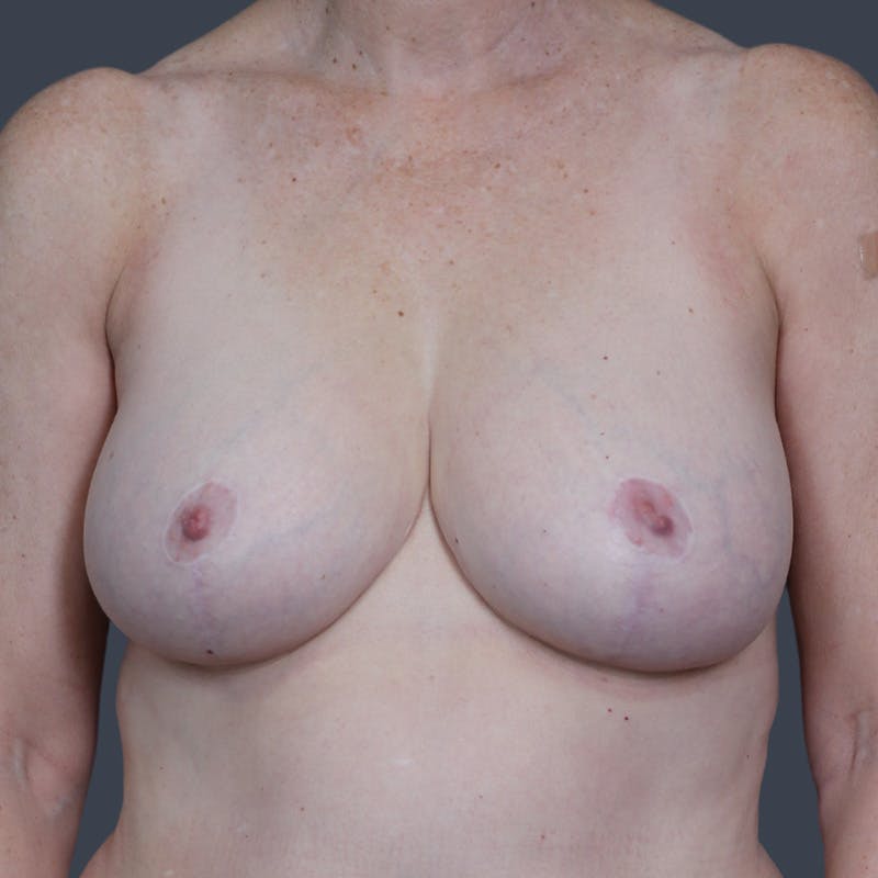 Breast Reduction Before & After Gallery - Patient 314917 - Image 2