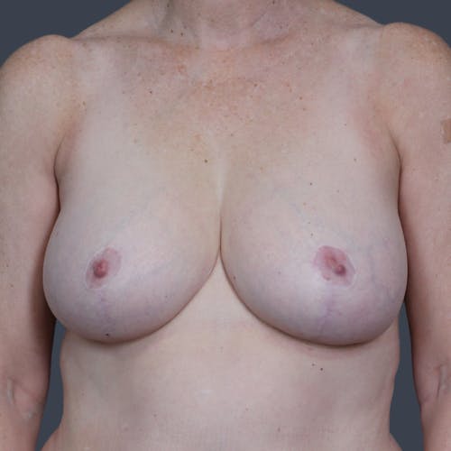 After procedure image for Breast Reduction