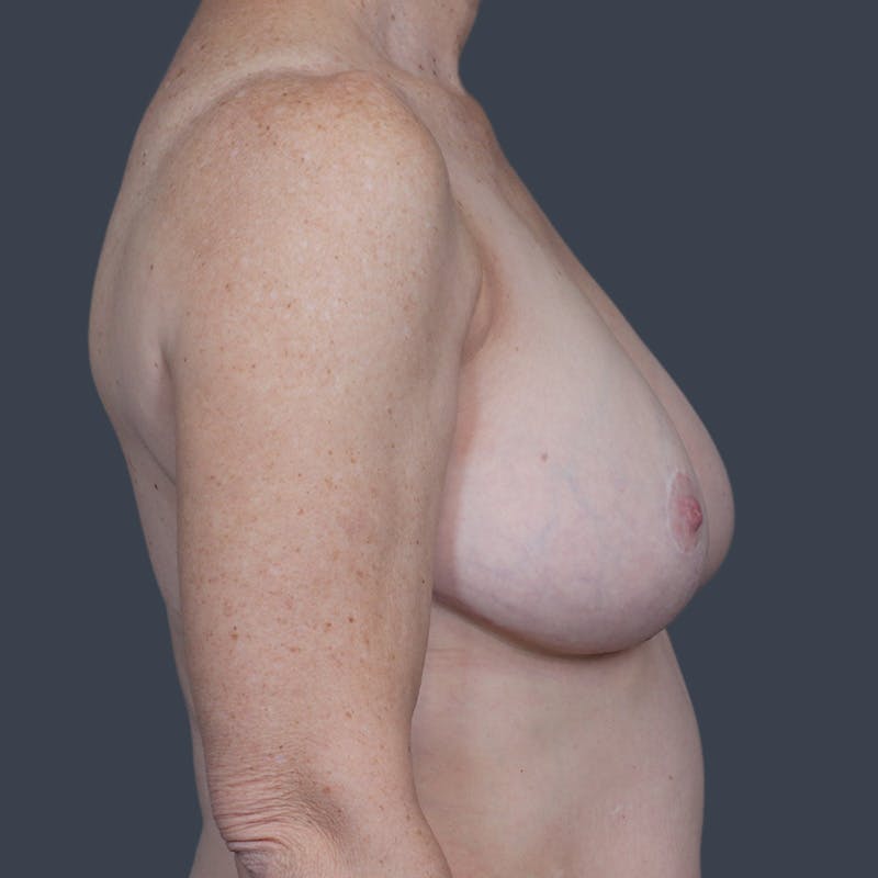 Breast Reduction Before & After Gallery - Patient 314917 - Image 6