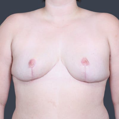 Breast Reduction Before & After Gallery - Patient 716063 - Image 2