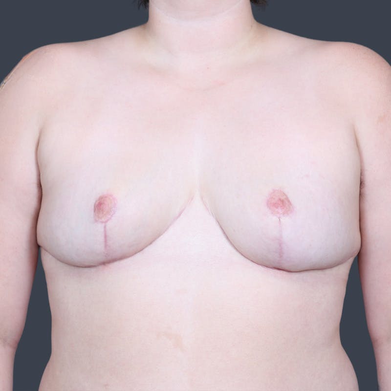 Breast Reduction Before & After Gallery - Patient 716063 - Image 2