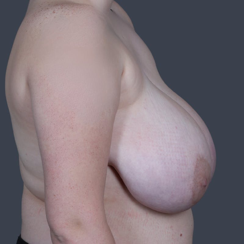 Breast Reduction Before & After Gallery - Patient 716063 - Image 5