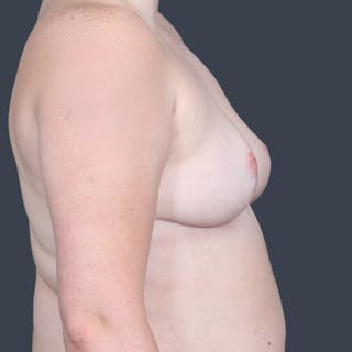 Breast Reduction Before & After Gallery - Patient 716063 - Image 6