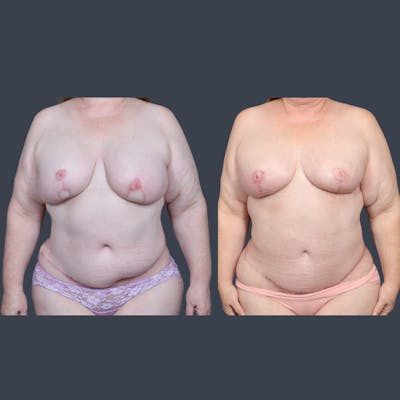 DIEP Flap Before & After Gallery - Patient 422312 - Image 2
