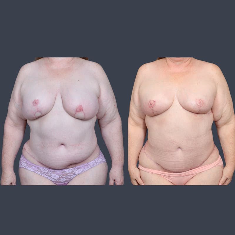 DIEP Flap Before & After Gallery - Patient 422312 - Image 2