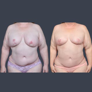 DIEP Flap Before & After Gallery - Patient 422312 - Image 2