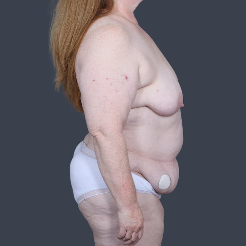 DIEP Flap Before & After Gallery - Patient 422312 - Image 3