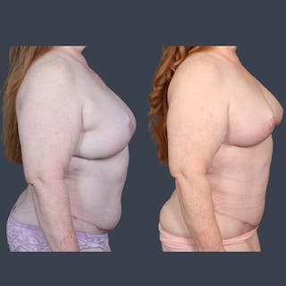 DIEP Flap Before & After Gallery - Patient 422312 - Image 4