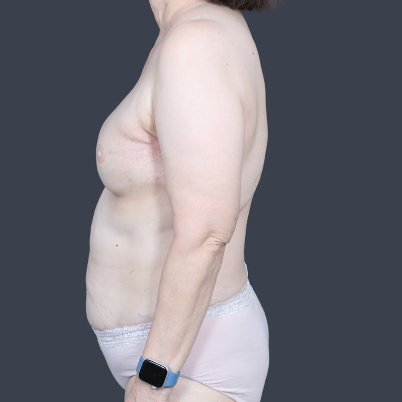 DIEP Flap Before & After Gallery - Patient 136299 - Image 5