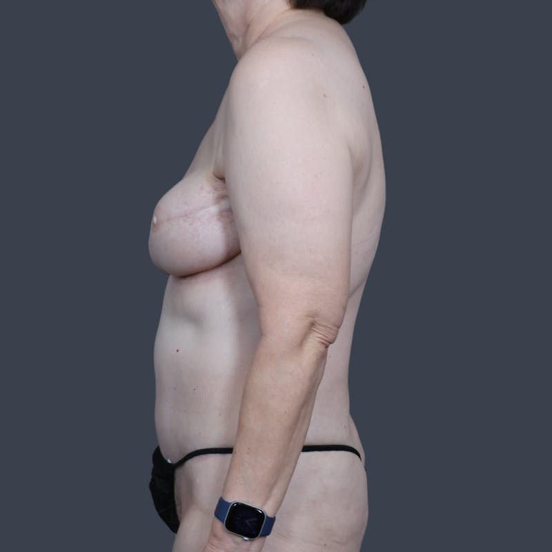 DIEP Flap Before & After Gallery - Patient 136299 - Image 6