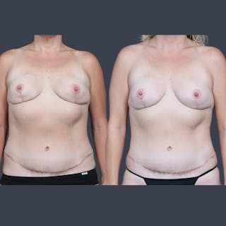 DIEP Flap Before & After Gallery - Patient 284451 - Image 2