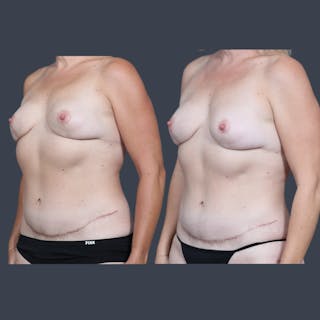 DIEP Flap Before & After Gallery - Patient 284451 - Image 4