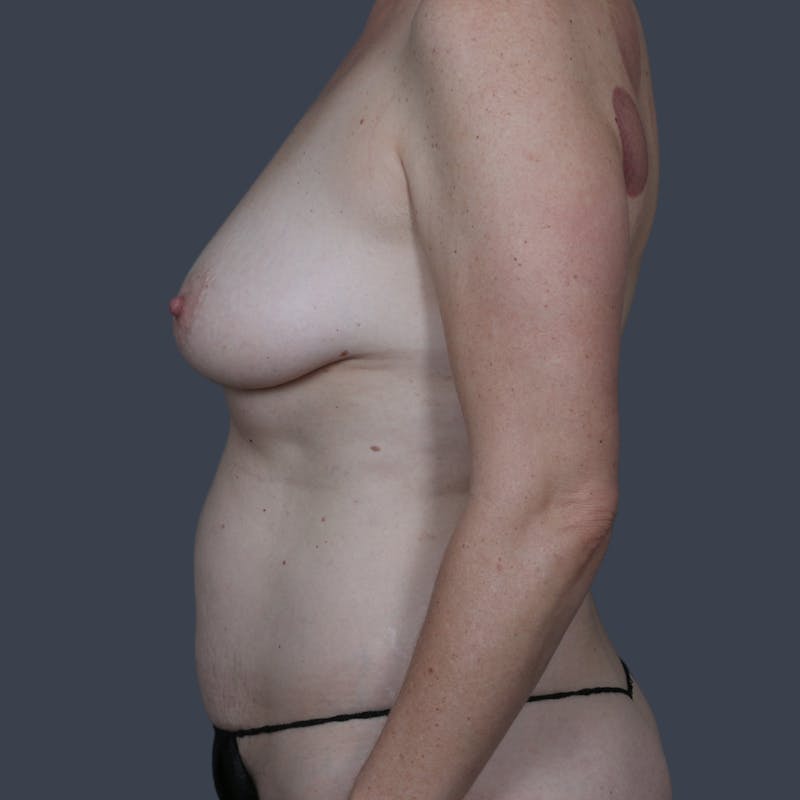DIEP Flap Before & After Gallery - Patient 284451 - Image 5