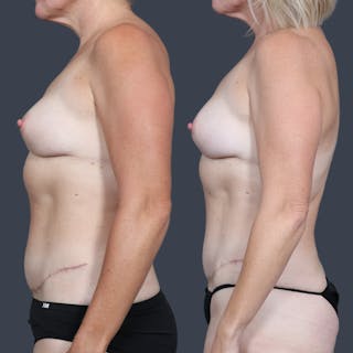 DIEP Flap Before & After Gallery - Patient 284451 - Image 6