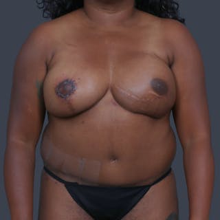 DIEP Flap Before & After Gallery - Patient 308687 - Image 2